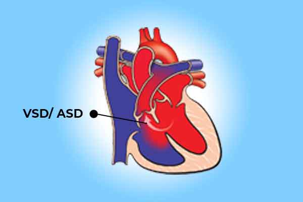 ASD AND VSD