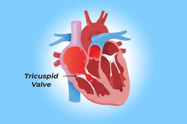 TRICUSPID VALVE STENOSIS