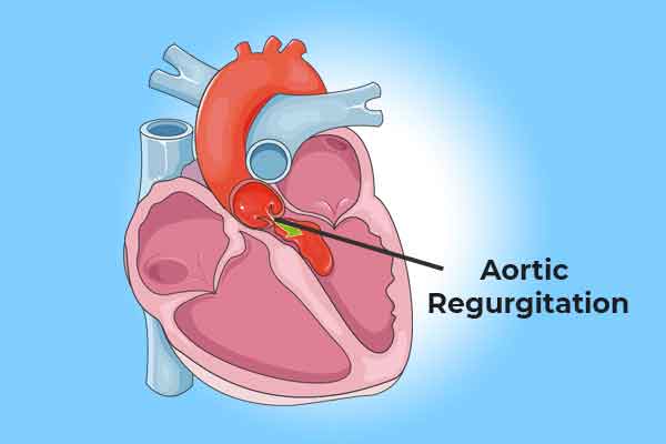 AORTIC VALVE PROLAPSE